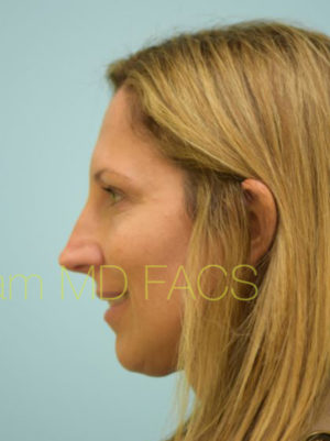 Eyelid Rejuvenation