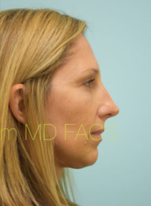 Eyelid Rejuvenation
