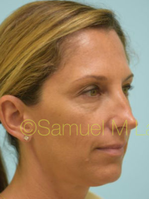 Eyelid Rejuvenation