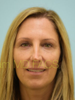 Eyelid Rejuvenation