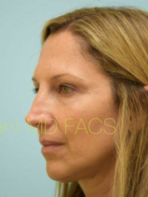 Eyelid Rejuvenation