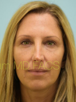 Eyelid Rejuvenation