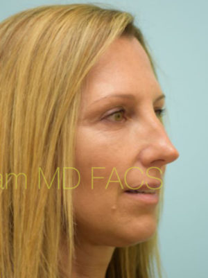 Eyelid Rejuvenation