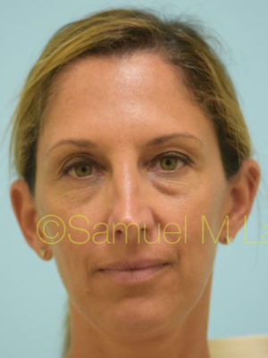 Eyelid Rejuvenation