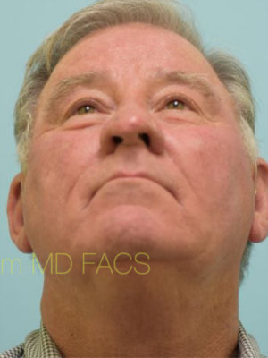 Rhinoplasty-Nose Job