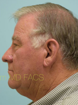 Rhinoplasty-Nose Job