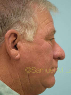 Rhinoplasty-Nose Job