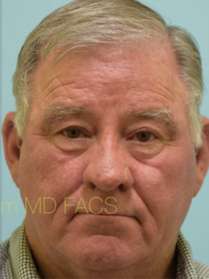 Rhinoplasty-Nose Job