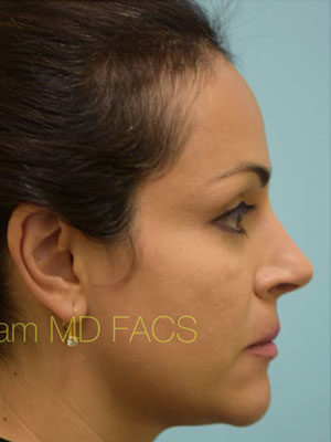Rhinoplasty-Nose Job