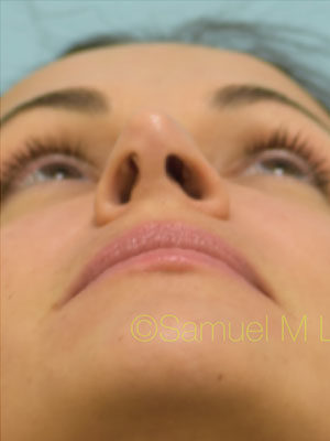 Rhinoplasty-Nose Job