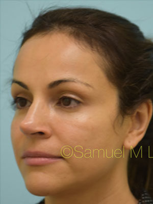 Rhinoplasty-Nose Job