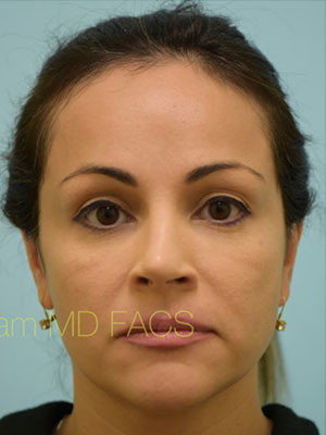 Rhinoplasty-Nose Job