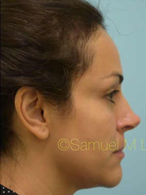 Rhinoplasty-Nose Job