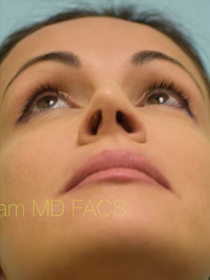 Rhinoplasty-Nose Job