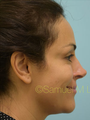 Rhinoplasty-Nose Job