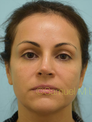 Rhinoplasty-Nose Job
