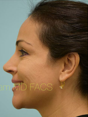 Rhinoplasty-Nose Job