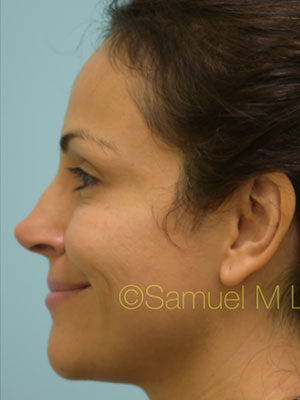 Rhinoplasty-Nose Job