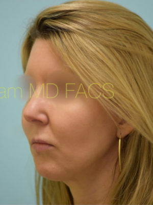 Chin Augmentation