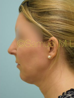 Chin Augmentation