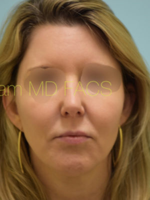 Chin Augmentation
