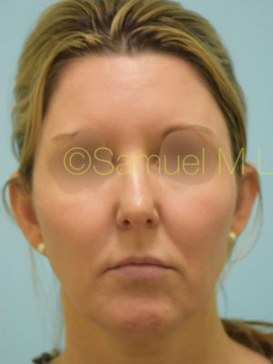 Chin Augmentation