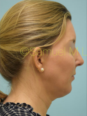 Chin Augmentation