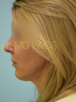 Chin Augmentation