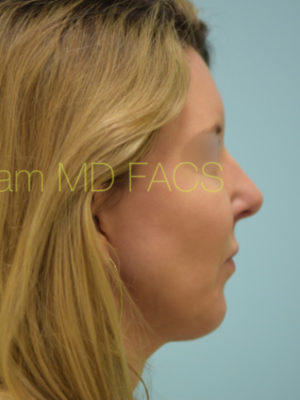 Chin Augmentation