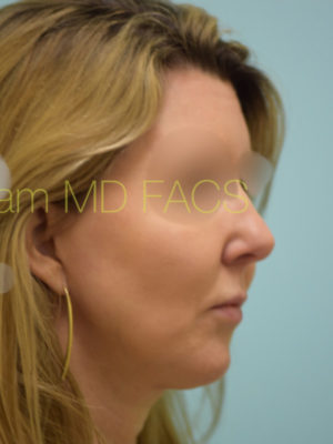 Chin Augmentation
