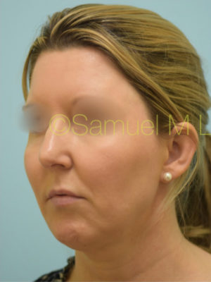 Chin Augmentation