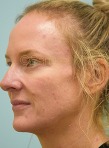 Eyelid Rejuvenation