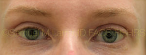 Eyelid Rejuvenation
