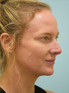 Eyelid Rejuvenation