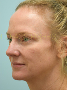 Eyelid Rejuvenation
