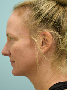 Eyelid Rejuvenation