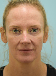 Eyelid Rejuvenation