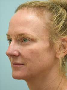 Eyelid Rejuvenation