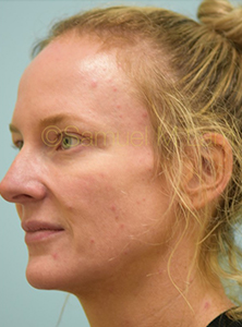 Eyelid Rejuvenation