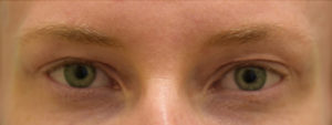 Eyelid Rejuvenation