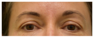 Eyelid Rejuvenation