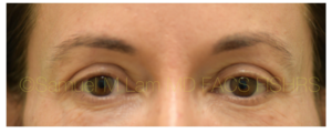 Eyelid Rejuvenation
