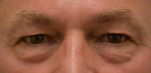 Eyelid Rejuvenation