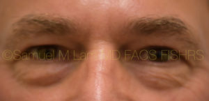 Eyelid Rejuvenation