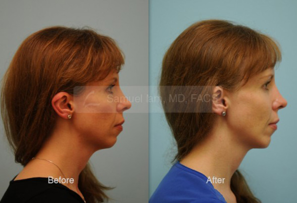 Cheek Augmentation Result Dallas