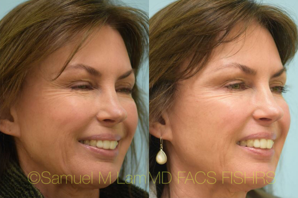 Dallas Botox Before and After Photos - Plano Plastic Surgery Photo Gallery  - Dr. Sam LamBotox Archives