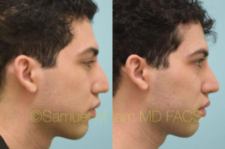 Nasal Tip Rhinoplasty Result Dallas