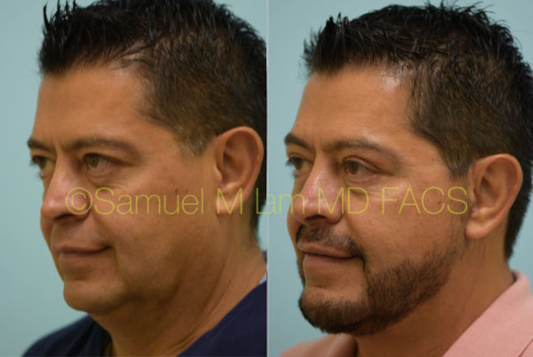 Cheek Augmentation Result Dallas