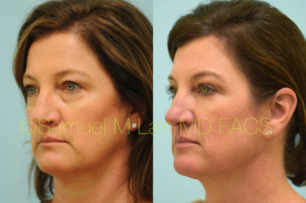 Dallas Botox Before and After Photos - Plano Plastic Surgery Photo Gallery  - Dr. Sam LamBotox Archives