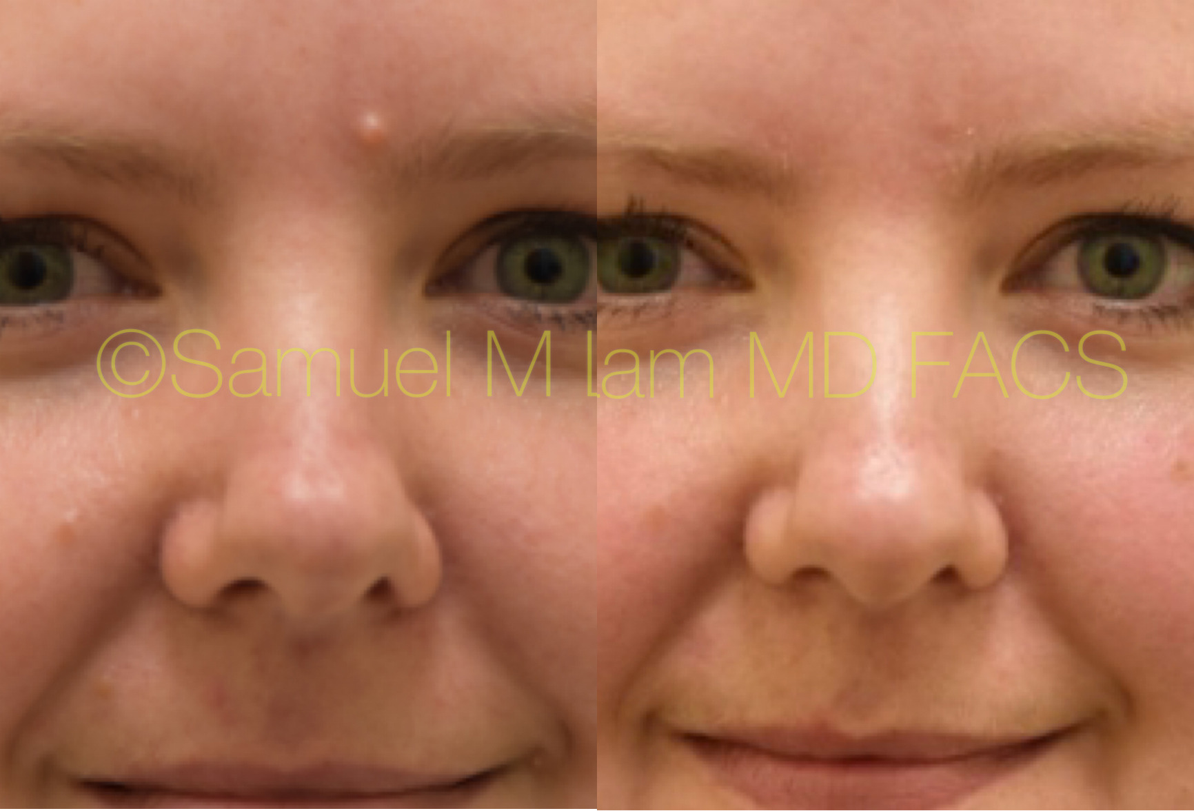 Facial Mole Removal Scarring